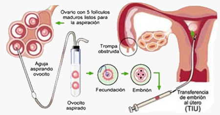 Ginecologia Tijuana - Centro de Fertilidad del Prado - Fertilizaci&oacute;n In Vitro