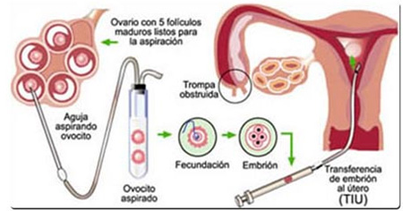 Ginecologia Tijuana - Centro de Fertilidad del Prado - Fertilizaci&oacute;n In Vitro